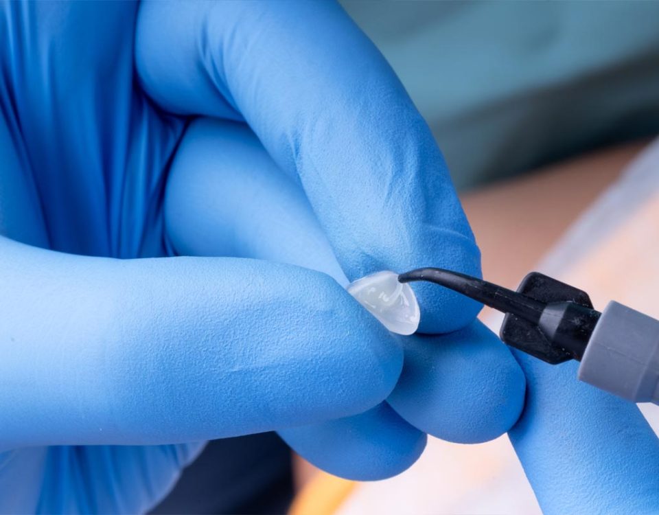 What Materials Are Used in Dental Sealants?