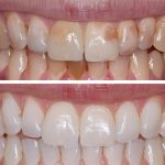 What You Should Know About Tooth Discoloration