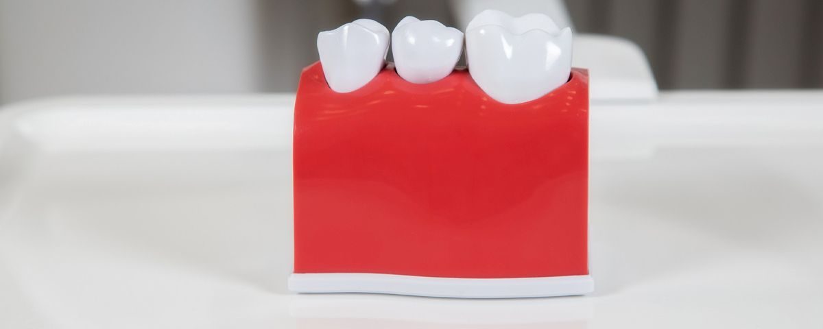 Will Gum Grow Around Implant Crown?