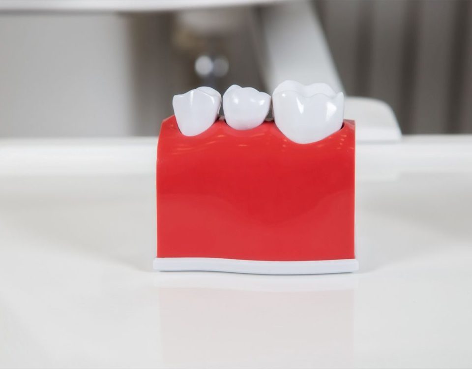 Will Gum Grow Around Implant Crown?