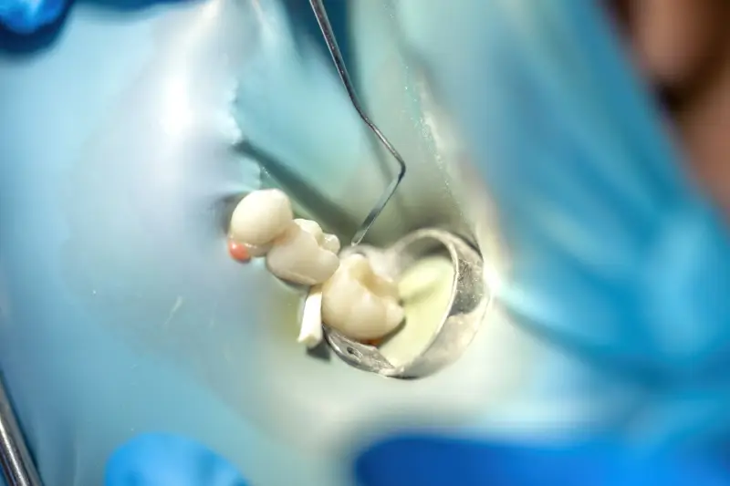 Dental Fillings Cost in Phoenix