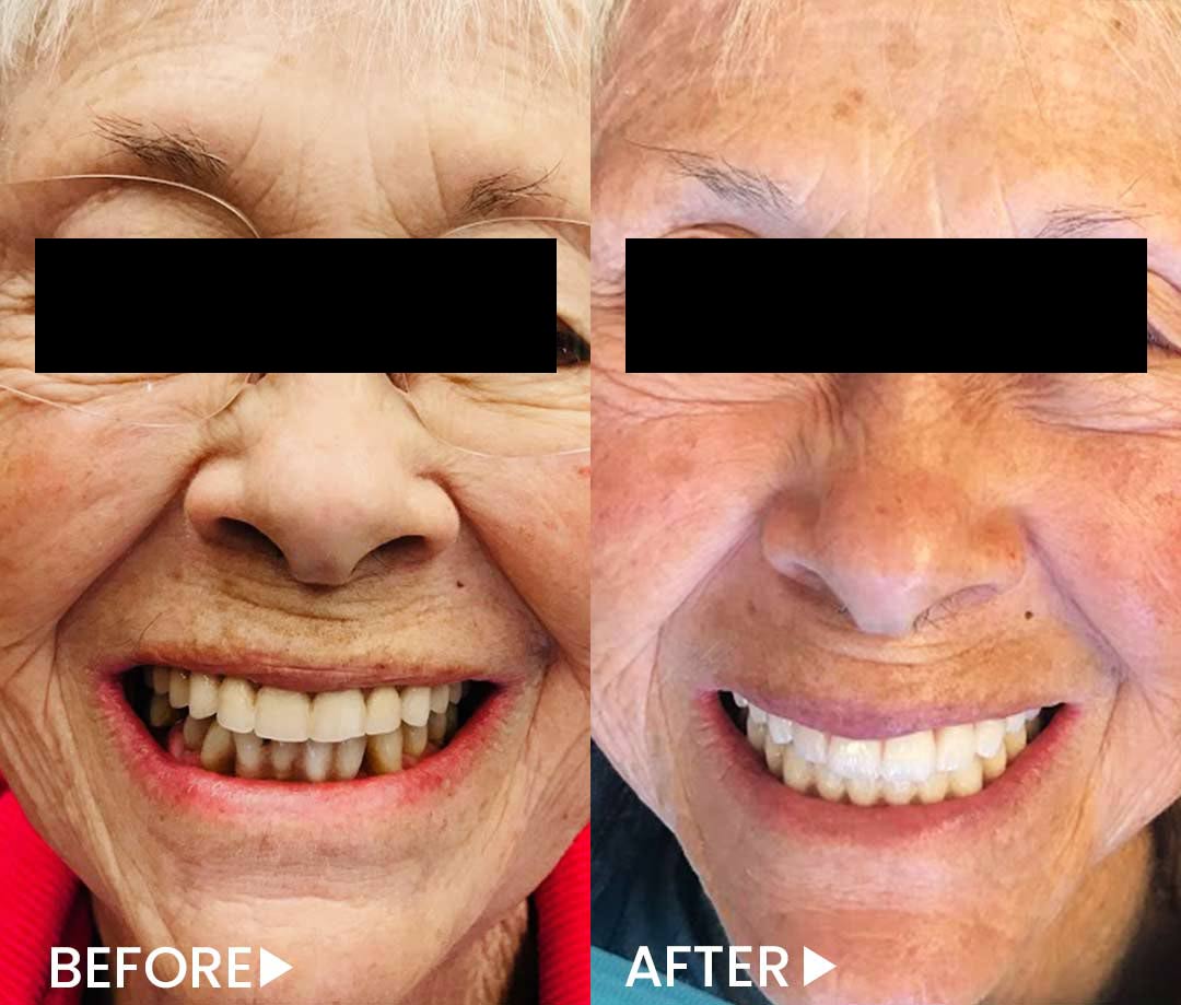 All-on-4 - Implants - Before After