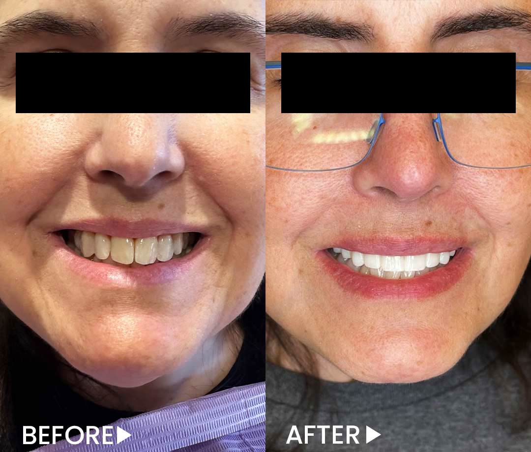 All-on-4 - Implants - Before After