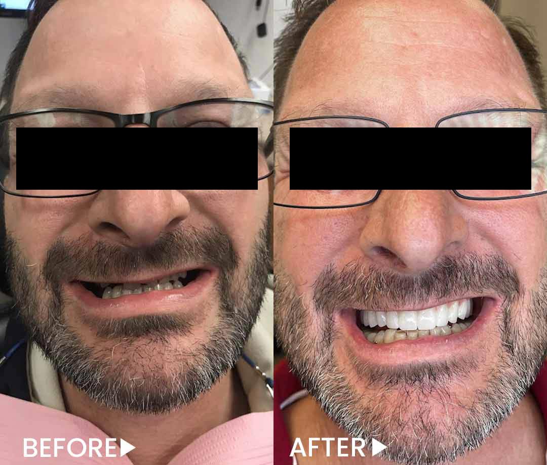 All-on-4 - Implants - Before After