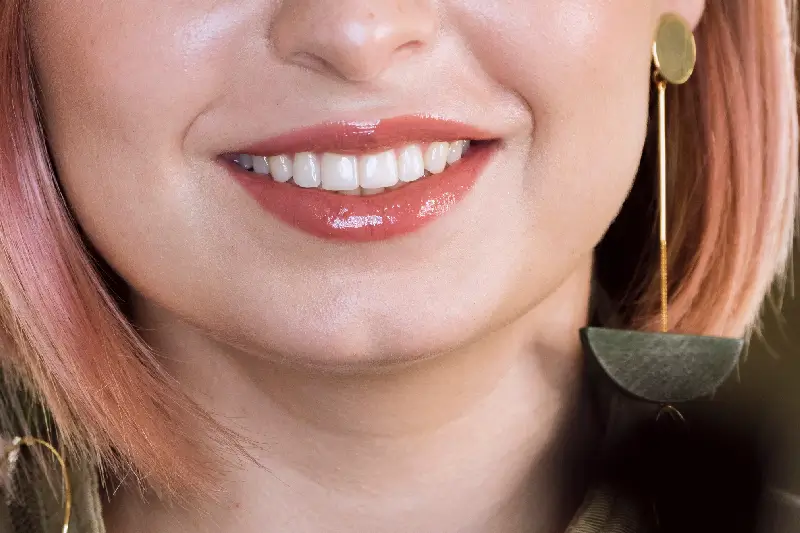 Composite Veneer Bonding Phoenix, AZ