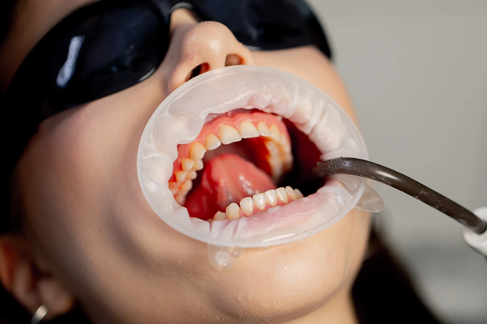 Full Mouth Reconstruction Cost in Phoenix