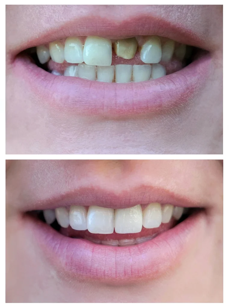 Porcelain Crowns Near Me in Phoenix