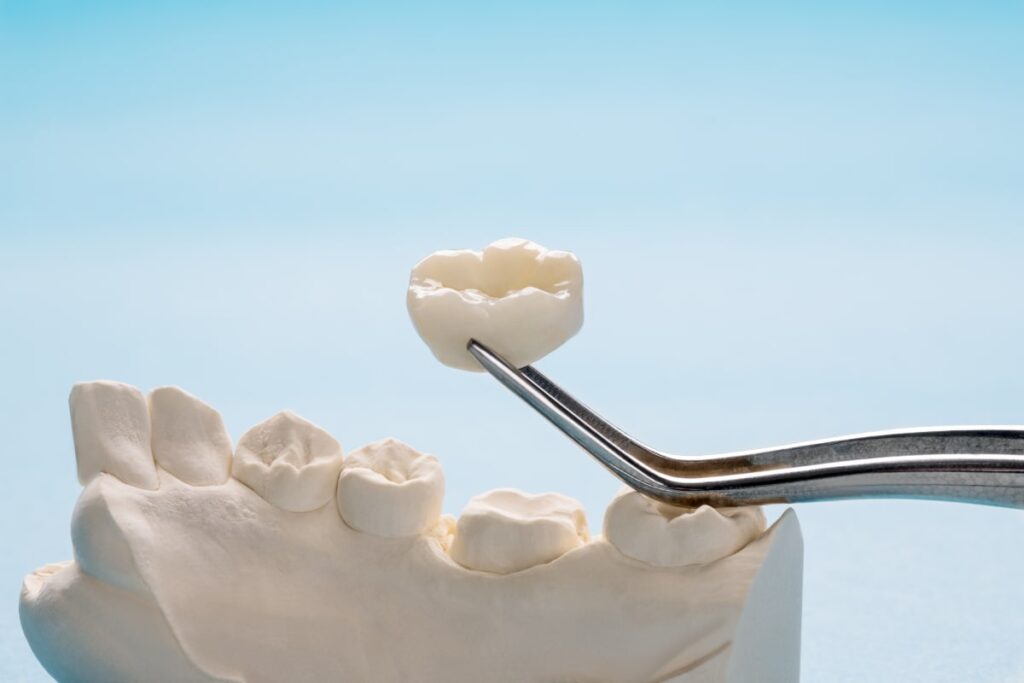 What is the Normal Cost of a Dental Bridge in Phoenix