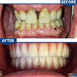 Before after Procedures: Full Smile Reconstruction