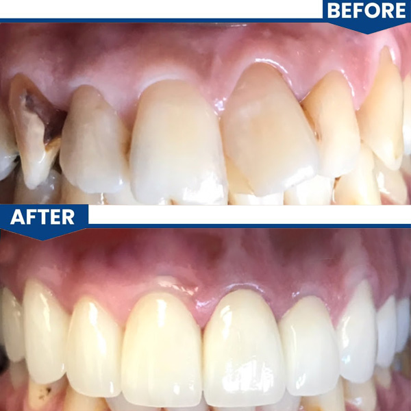 Before After Procedures Same Day Implants