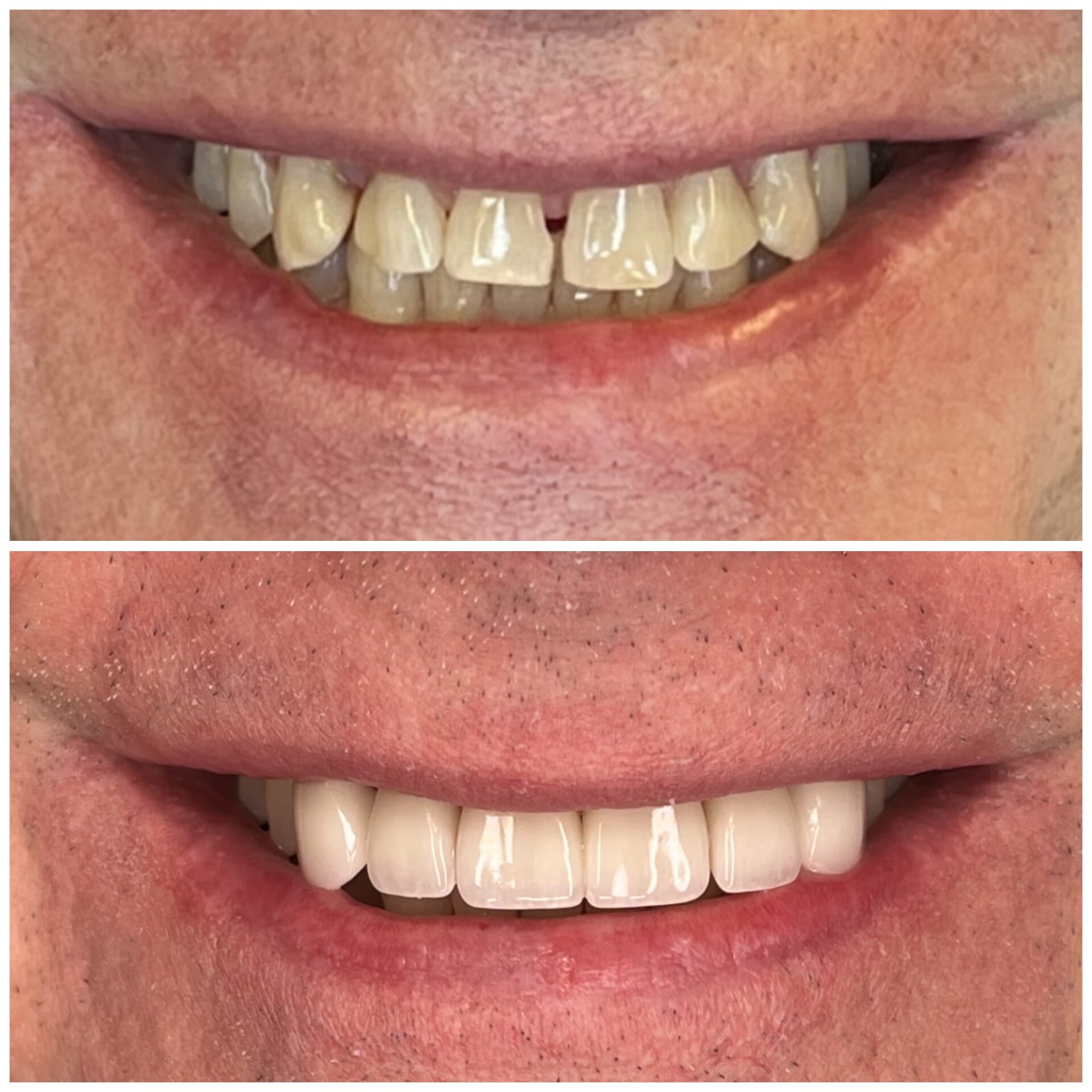 Before and after dental transformation