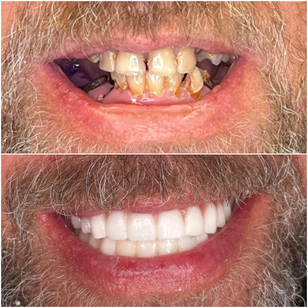 Before and after full arch dental transformation